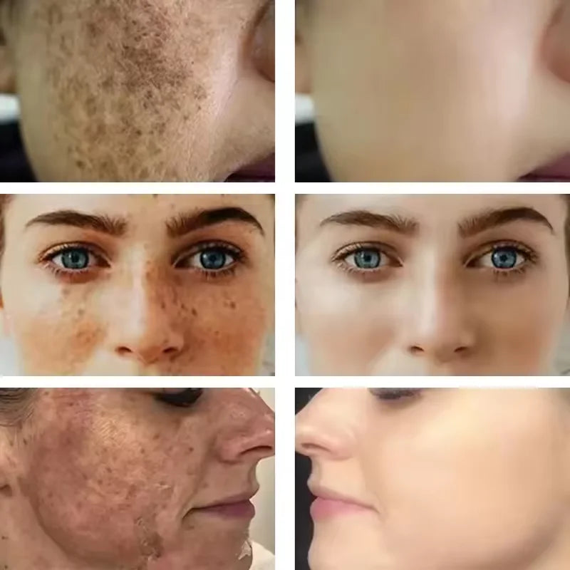 Vitamin E Dark Spots Remover Capsule Face Freckle Melanin Correct Anti Pigmentation Brighten Beauty Korean Day Night Skin Care