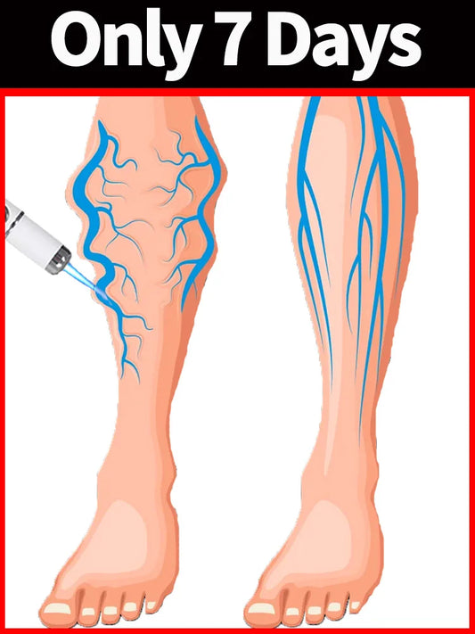 blue light pen solve varicose veins, hot sale leg care tools